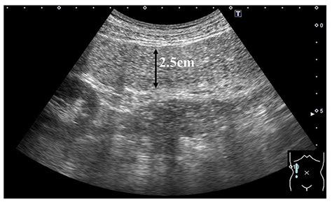 test to rule out impaction|Fecal Impaction .